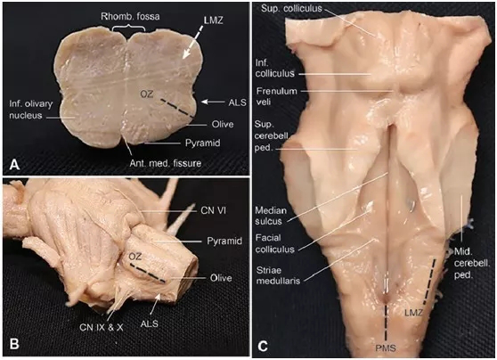 腦干延髓腫瘤順利全切可能嗎？?jī)蓜t成功案例交流
