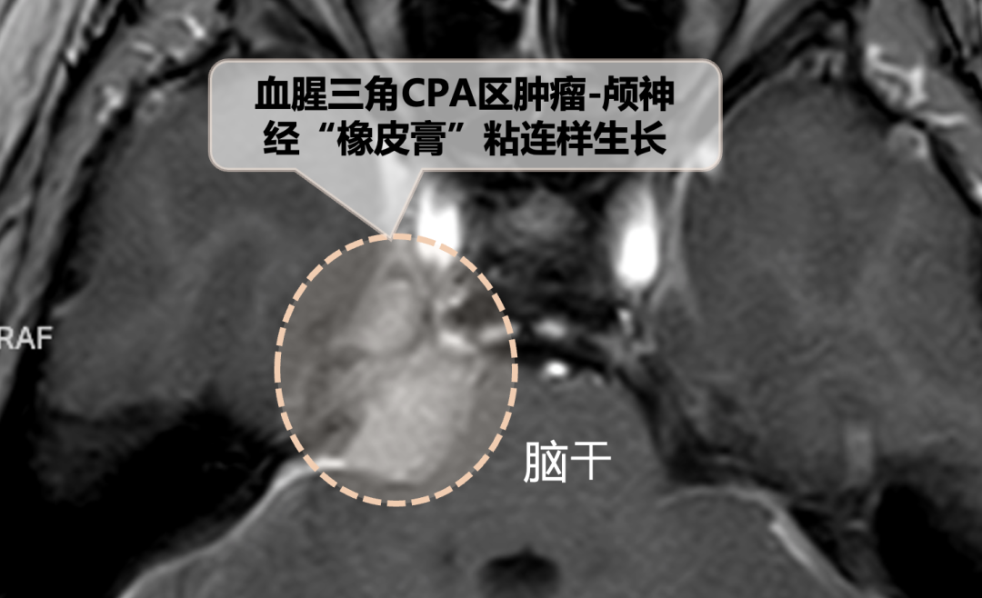 天壇醫(yī)院手術(shù)隨訪 | “無(wú)癥狀”腦瘤要不要切？一場(chǎng)手術(shù)讓她重獲“說(shuō)走就走”的西藏之旅