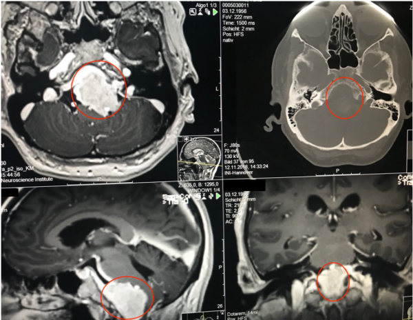 較大巖斜區(qū)腦膜瘤全切案例