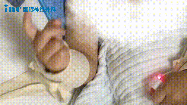 北京天壇醫(yī)院手術(shù)紀(jì)實(shí) - 母子連心戰(zhàn)勝腦干膠質(zhì)瘤，全家人的開心果又回來(lái)啦！